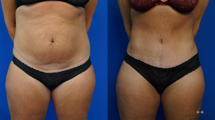 Before & After Tummy Tuck Case 461 Front View in Fort Worth, Texas