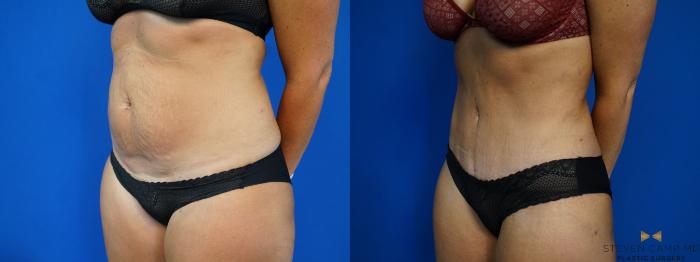 Before & After Tummy Tuck Case 461 Left Oblique View in Fort Worth, Texas