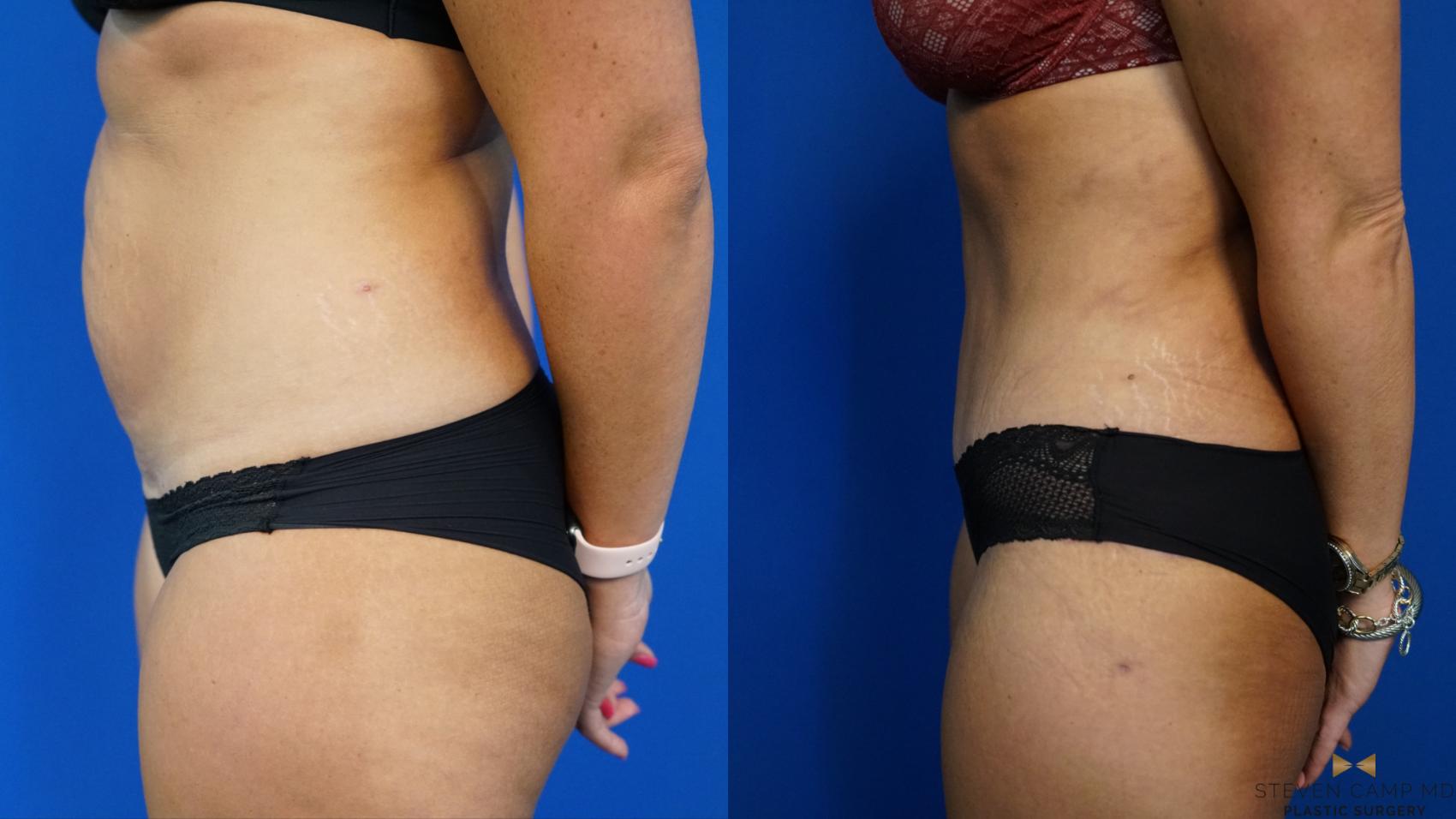 Before & After Tummy Tuck Case 461 Left Side View in Fort Worth, Texas
