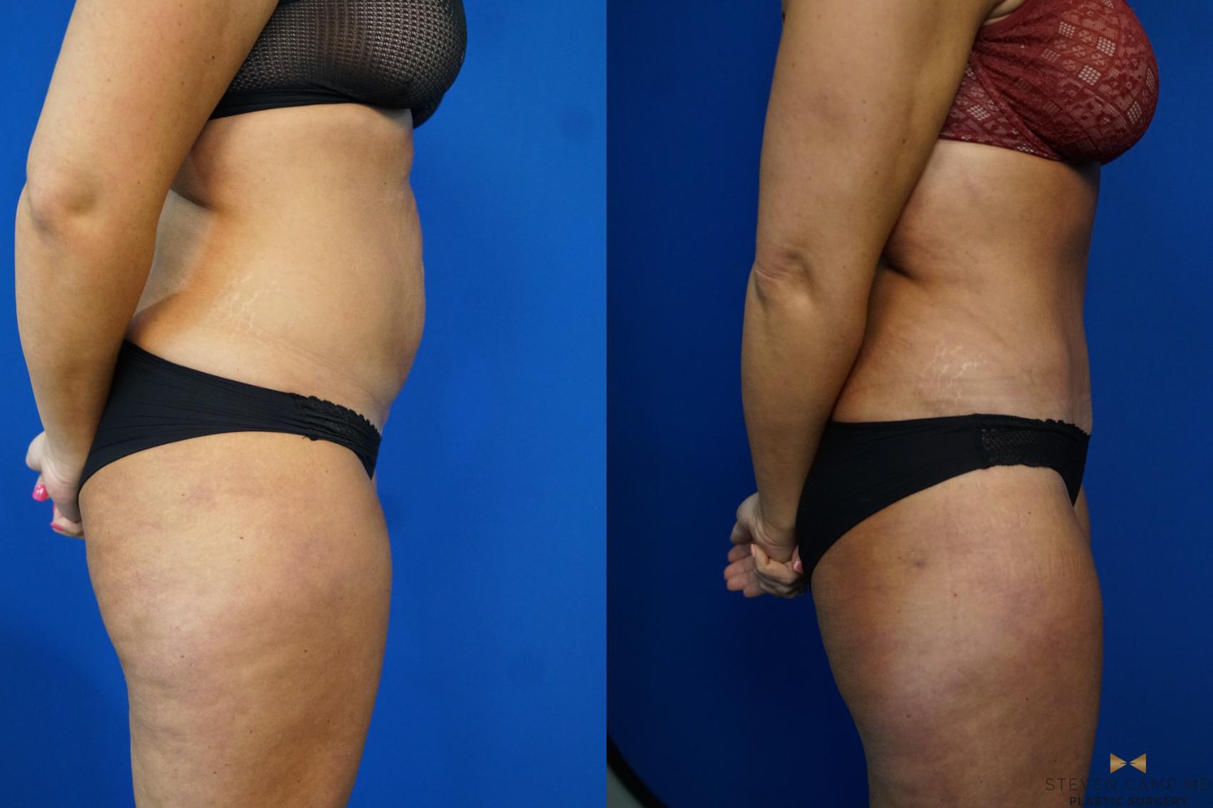 Before & After Tummy Tuck Case 461 Right Side View in Fort Worth & Arlington, Texas