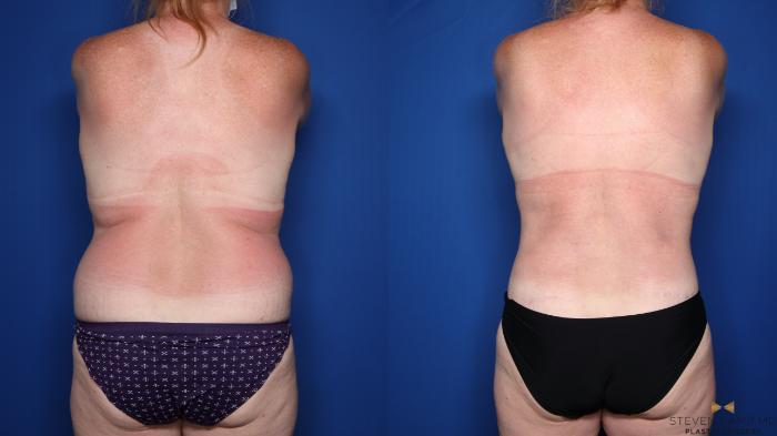 Before & After Tummy Tuck Case 479 Back View in Fort Worth & Arlington, Texas