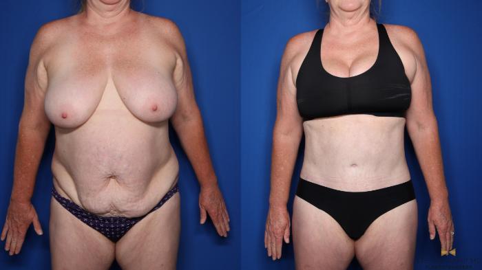 Before & After Tummy Tuck Case 479 Front View in Fort Worth & Arlington, Texas