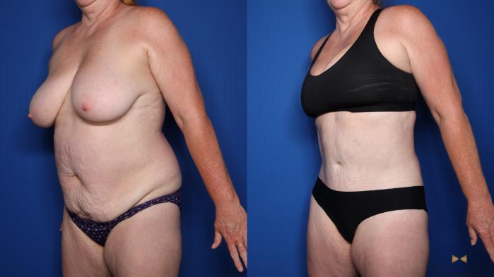 Before & After Tummy Tuck Case 479 Left Oblique View in Fort Worth & Arlington, Texas