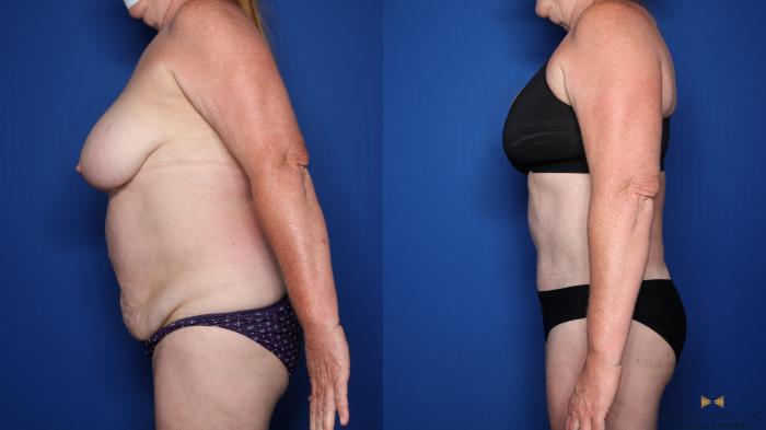 Before & After Tummy Tuck Case 479 Left Side View in Fort Worth & Arlington, Texas