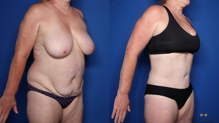 Before & After Liposuction Case 479 Right Oblique View in Fort Worth & Arlington, Texas