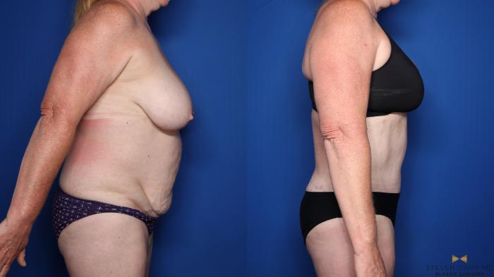 Before & After Tummy Tuck Case 479 Right Side View in Fort Worth & Arlington, Texas