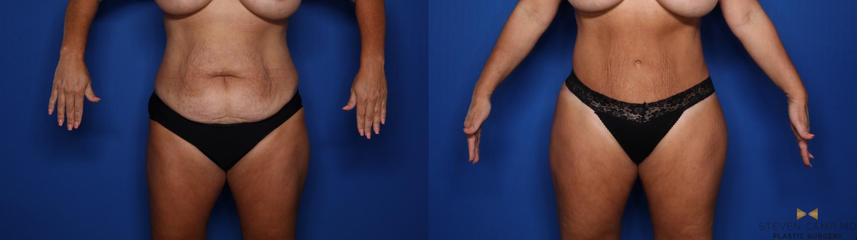 Before & After Tummy Tuck Case 495 Front View in Fort Worth & Arlington, Texas