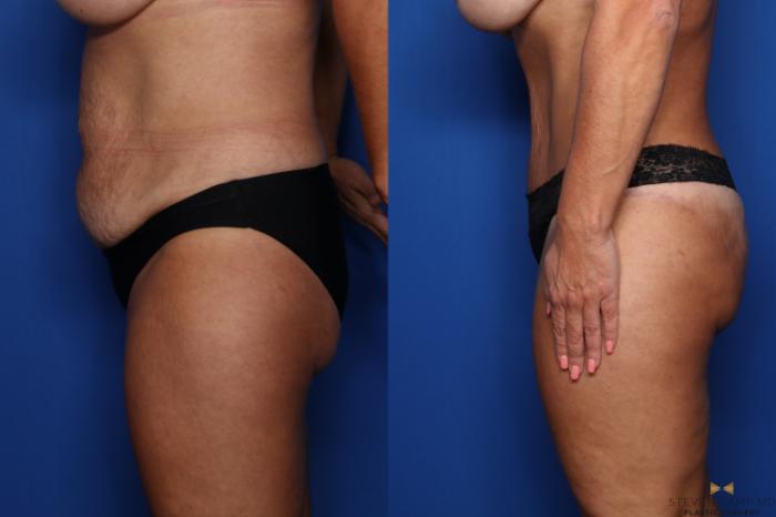 Before & After Tummy Tuck Case 495 Left Side View in Fort Worth & Arlington, Texas