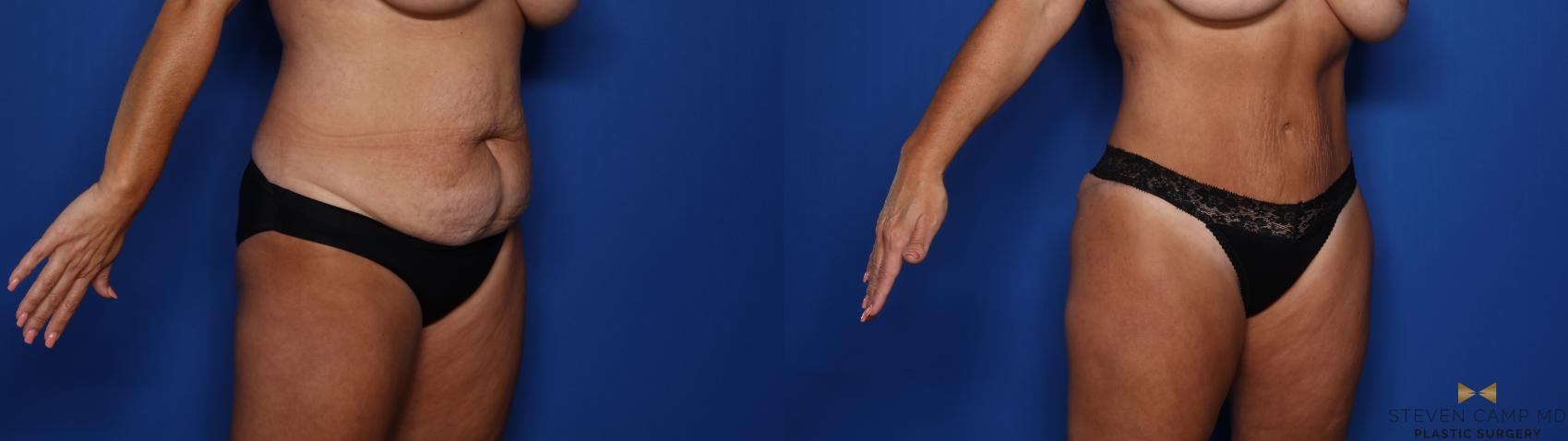 Before & After Tummy Tuck Case 495 Right Oblique View in Fort Worth & Arlington, Texas