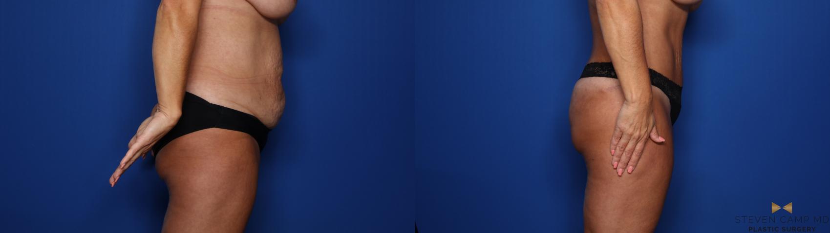 Before & After Tummy Tuck Case 495 Right Side View in Fort Worth & Arlington, Texas