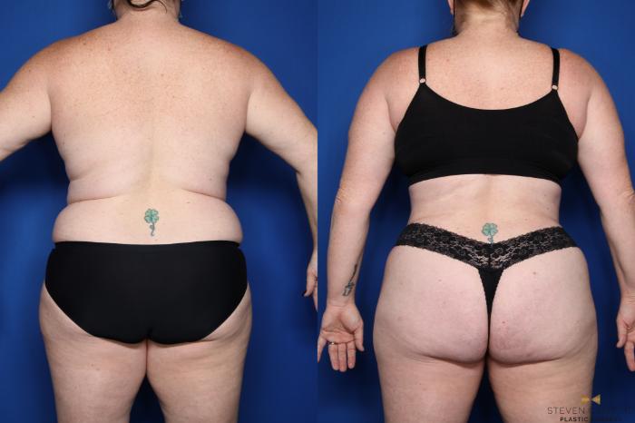 Before & After Tummy Tuck Case 510 Back View in Fort Worth, Texas