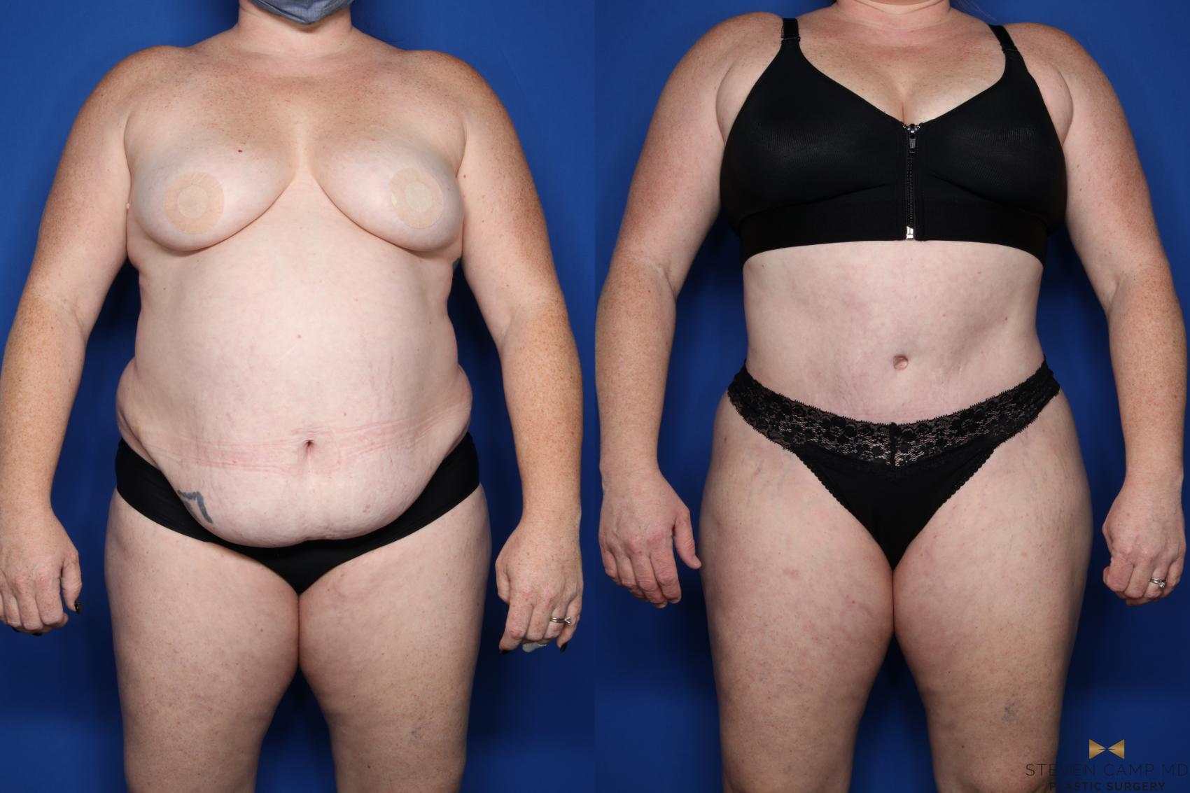 Before & After Tummy Tuck Case 510 Front View in Fort Worth & Arlington, Texas