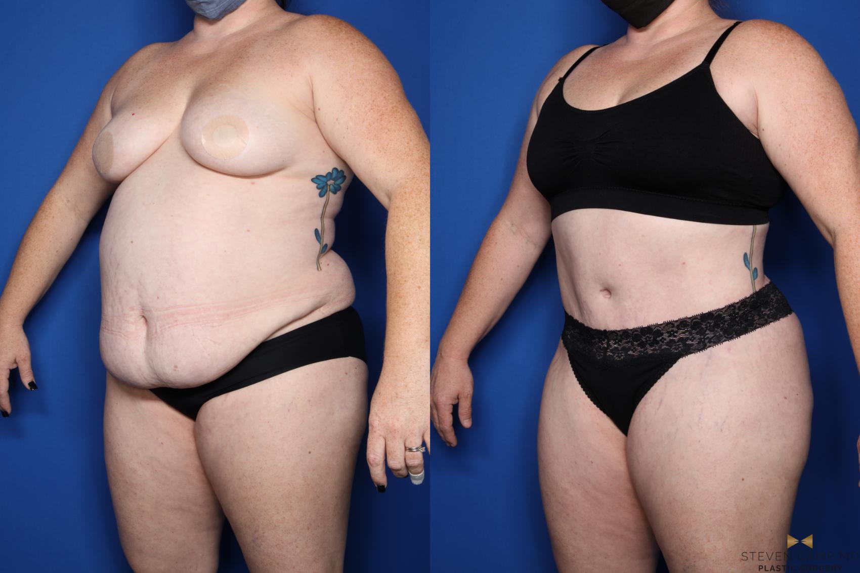 Before & After Tummy Tuck Case 510 Left Oblique View in Fort Worth, Texas