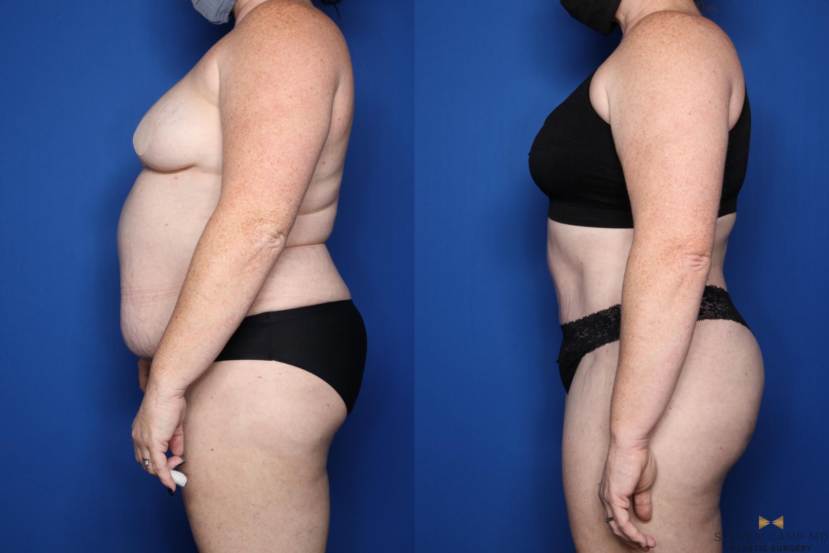 Before & After Tummy Tuck Case 510 Left Side View in Fort Worth & Arlington, Texas