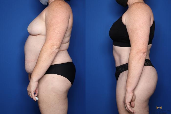 Before & After Tummy Tuck Case 510 Left Side View in Fort Worth, Texas
