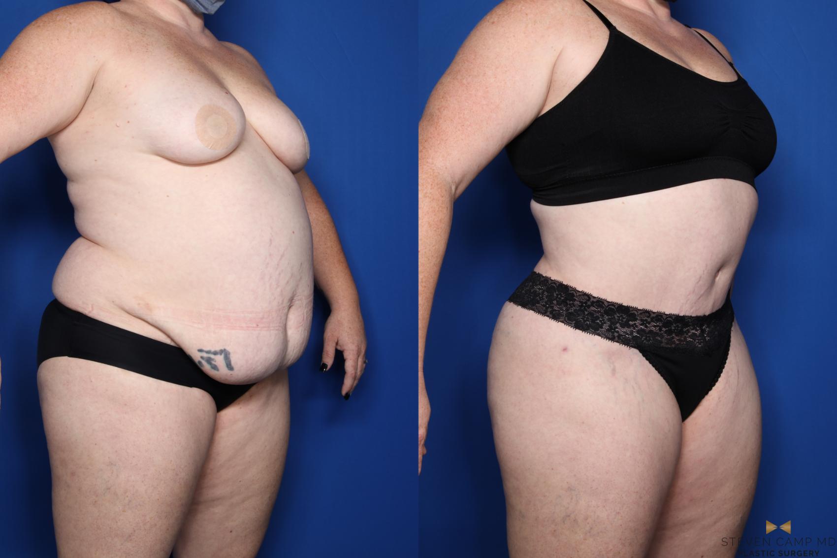 Before & After Tummy Tuck Case 510 Right Oblique View in Fort Worth & Arlington, Texas