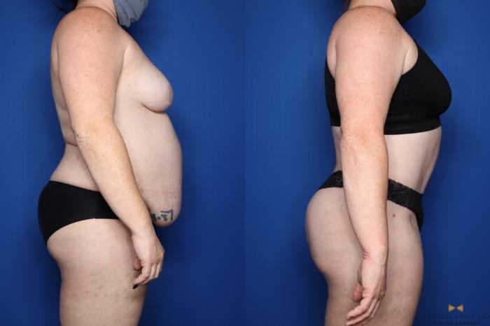 Before & After Tummy Tuck Case 510 Right Side View in Fort Worth, Texas