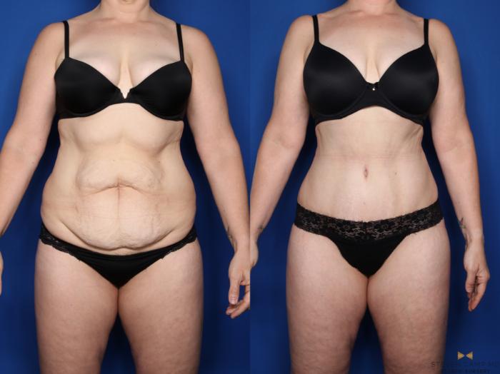 Before & After Liposuction Case 537 Front View in Fort Worth & Arlington, Texas