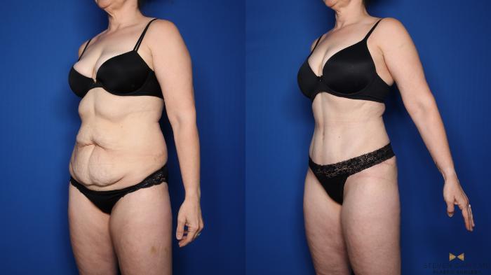 Before & After Tummy Tuck Case 537 Left Oblique View in Fort Worth & Arlington, Texas