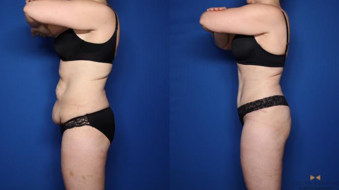 Before & After Liposuction Case 537 Left Side View in Fort Worth & Arlington, Texas