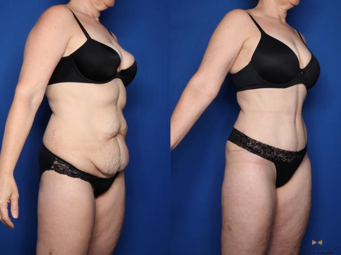 Before & After Tummy Tuck Case 537 Right Oblique View in Fort Worth & Arlington, Texas
