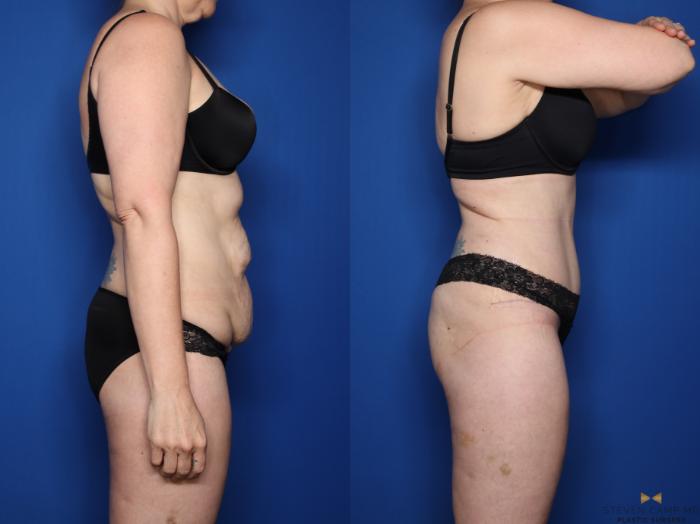 Before & After Liposuction Case 537 Right Side View in Fort Worth & Arlington, Texas