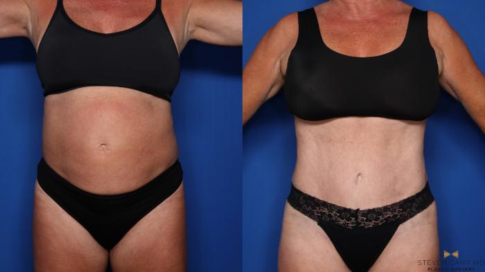 Before & After Tummy Tuck Case 554 Front View in Fort Worth & Arlington, Texas