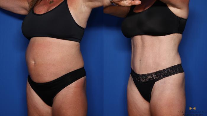 Before & After Liposuction Case 554 Left Oblique View in Fort Worth & Arlington, Texas