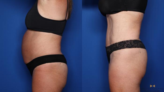 Before & After Tummy Tuck Case 554 Left Side View in Fort Worth & Arlington, Texas