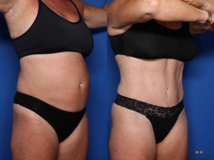 Before & After Liposuction Case 554 Right Oblique View in Fort Worth & Arlington, Texas
