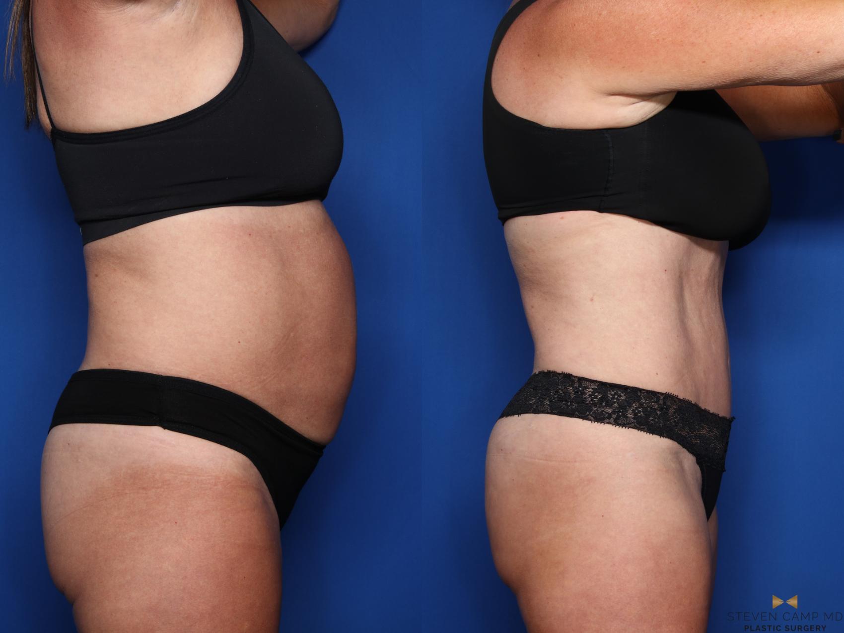 Before & After Liposuction Case 554 Right Side View in Fort Worth & Arlington, Texas