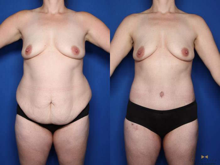 Before & After Tummy Tuck Case 557 Front View in Fort Worth & Arlington, Texas