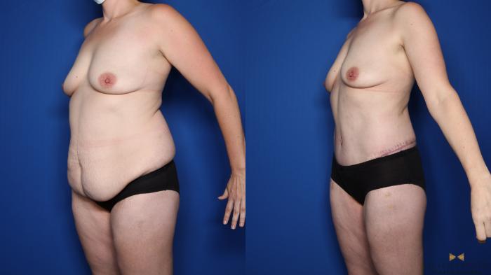 Before & After Tummy Tuck Case 557 Left Oblique View in Fort Worth & Arlington, Texas