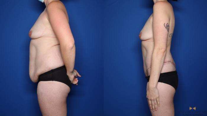 Before & After Tummy Tuck Case 557 Left Side View in Fort Worth & Arlington, Texas