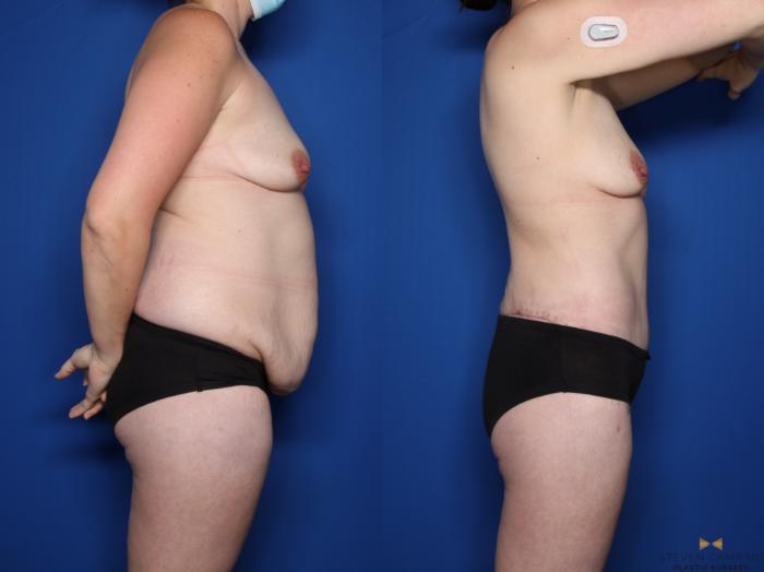 Before & After Tummy Tuck Case 557 Right Side View in Fort Worth & Arlington, Texas