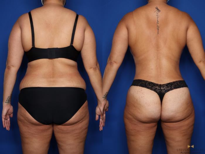 Before & After Tummy Tuck Case 569 Back View in Fort Worth & Arlington, Texas