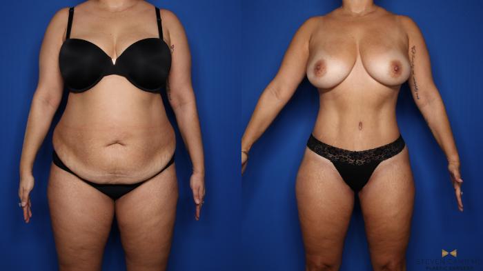 Before & After Liposuction Case 569 Front View in Fort Worth & Arlington, Texas