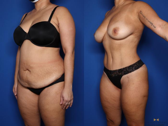 Before & After Tummy Tuck Case 569 Left Oblique View in Fort Worth & Arlington, Texas