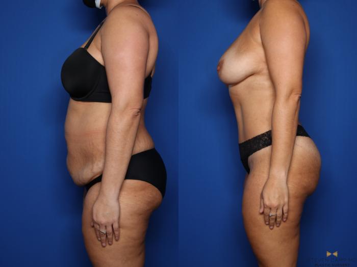 Before & After Tummy Tuck Case 569 Left Side View in Fort Worth & Arlington, Texas