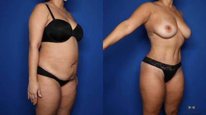 Before & After Liposuction Case 569 Right Oblique View in Fort Worth & Arlington, Texas