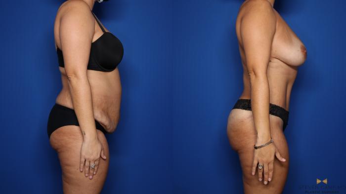 Before & After Liposuction Case 569 Right Side View in Fort Worth & Arlington, Texas