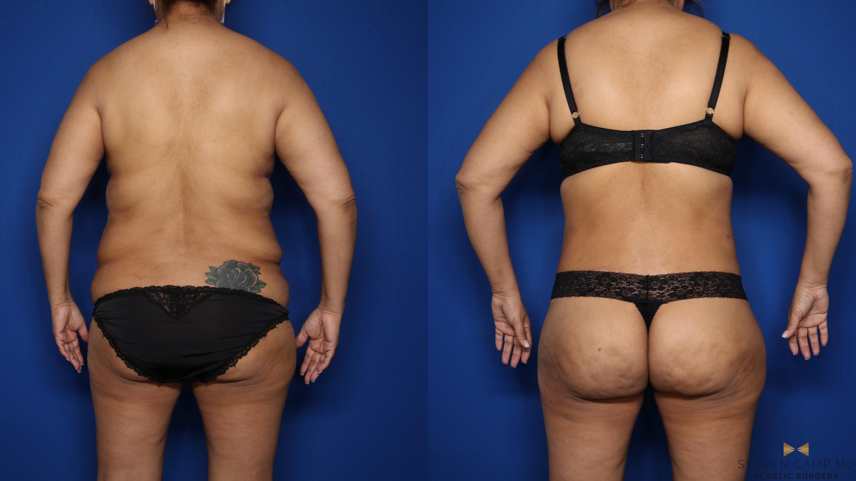 Before & After Tummy Tuck Case 577 Back View in Fort Worth & Arlington, Texas