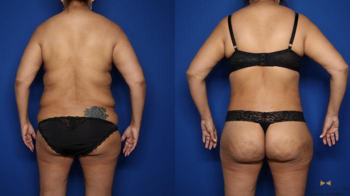 Before & After Tummy Tuck Case 577 Back View in Fort Worth & Arlington, Texas
