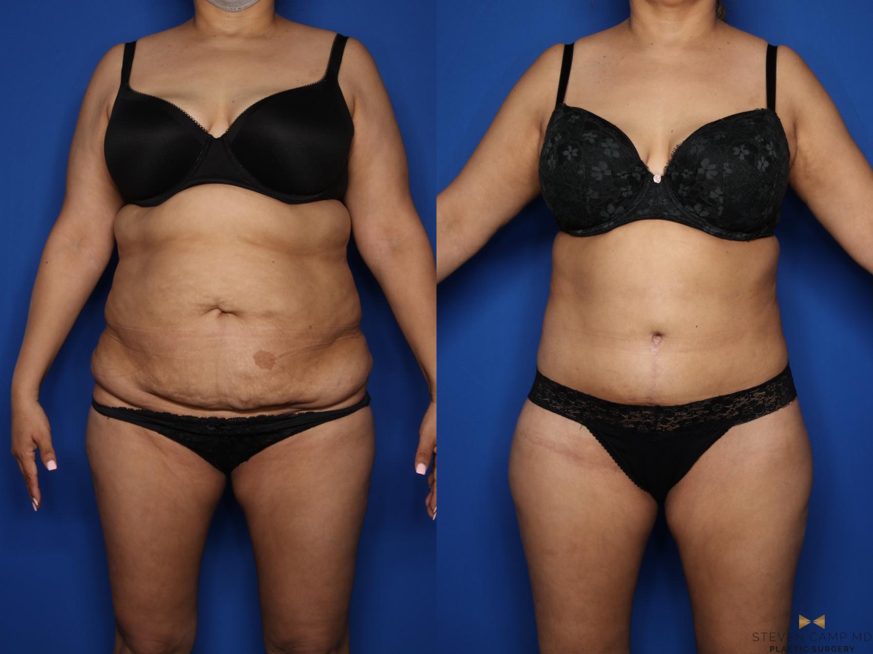 Before & After Tummy Tuck Case 577 Front View in Fort Worth & Arlington, Texas