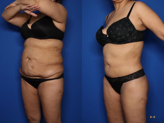 Before & After Tummy Tuck Case 577 Left Oblique View in Fort Worth & Arlington, Texas