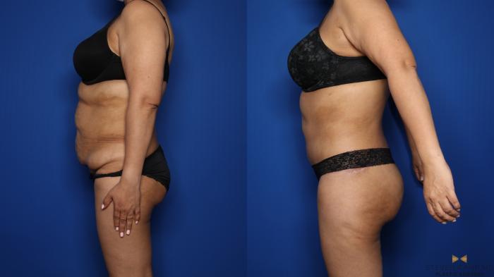Before & After Tummy Tuck Case 577 Left Side View in Fort Worth & Arlington, Texas
