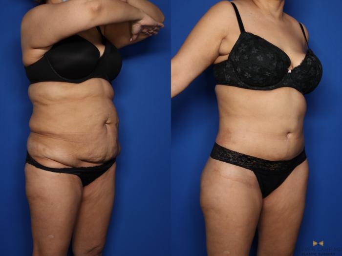 Before & After Tummy Tuck Case 577 Right Oblique View in Fort Worth & Arlington, Texas