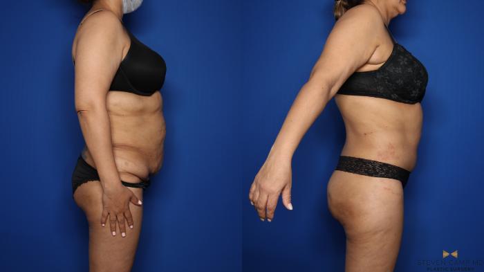 Before & After Tummy Tuck Case 577 Right Side View in Fort Worth & Arlington, Texas