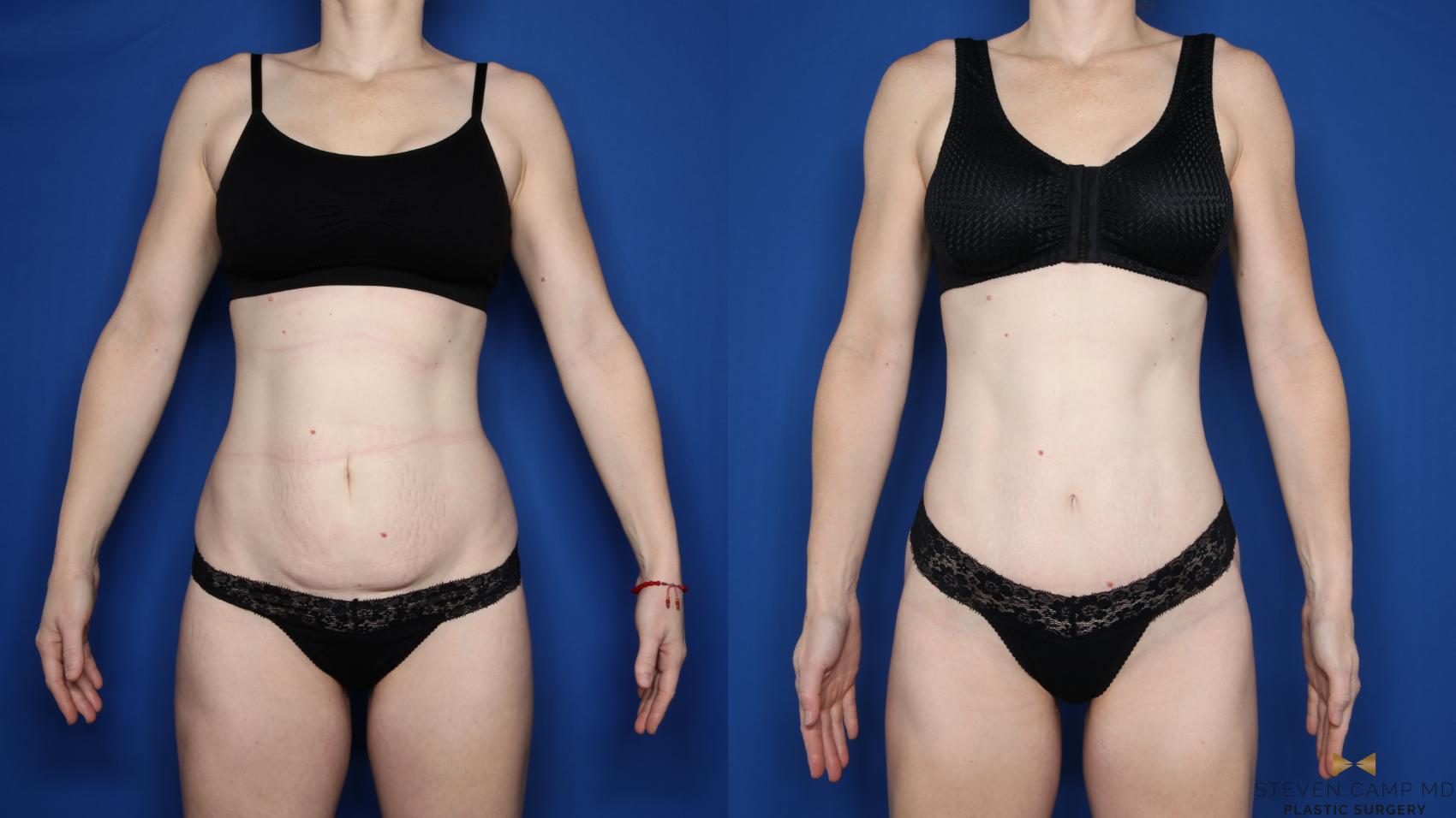 Before & After Tummy Tuck Case 595 Front View in Fort Worth & Arlington, Texas