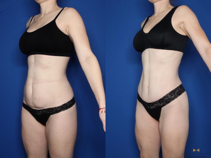 Before & After Tummy Tuck Case 595 Left Oblique View in Fort Worth & Arlington, Texas